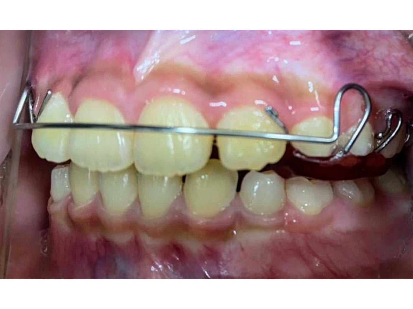 口腔内写真2