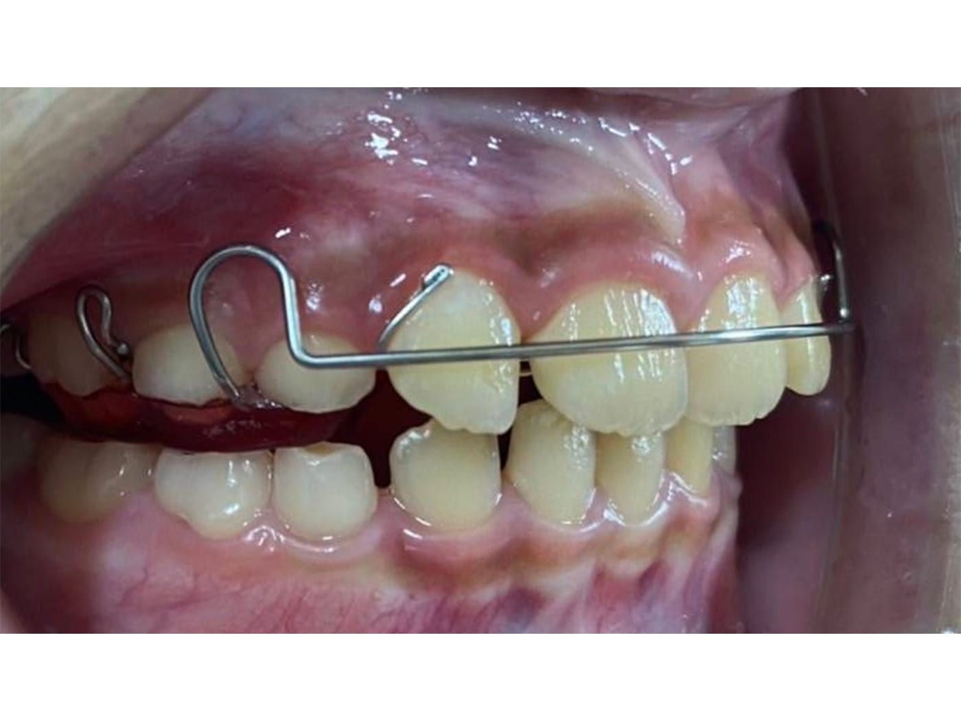 口腔内写真3